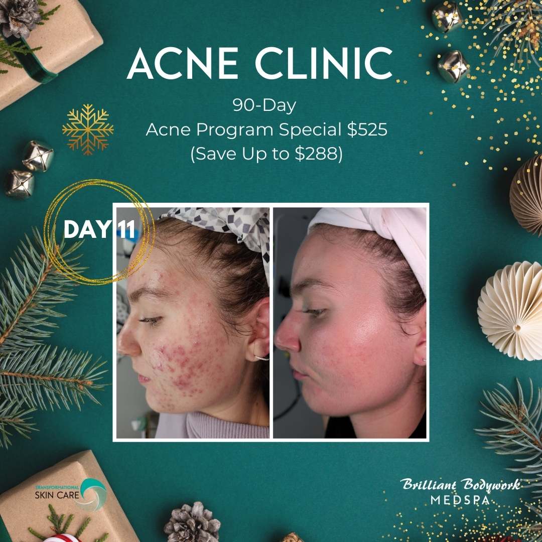 Day 11 - 90 Day Acne Program Offer