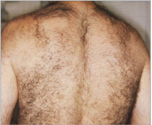 Image showing hair growth on a back prior to treatment.
