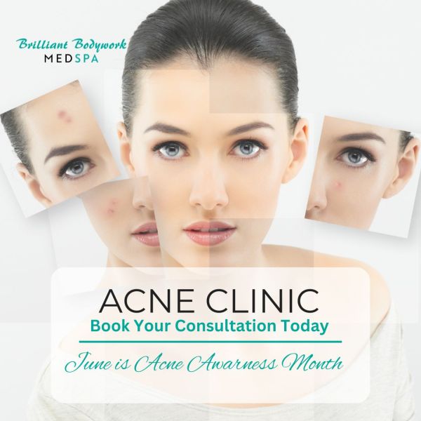 Click this image to Book your Acne Clinic Consultation